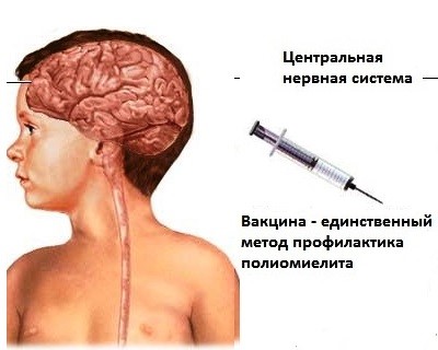 Полиомиелит – это острая вирусная инфекция, характеризующаяся поражением спинного мозга и других отделов центральной нервной системы.  Специалисты утверждают, что обычно болезнь протекает без симптомов или в стертом виде с неяркими проявлениями. Но тяжелы.